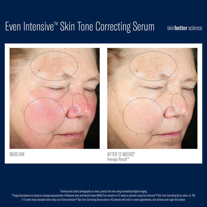 SkinBetter Even Intensive Skin Tone Correcting Serum