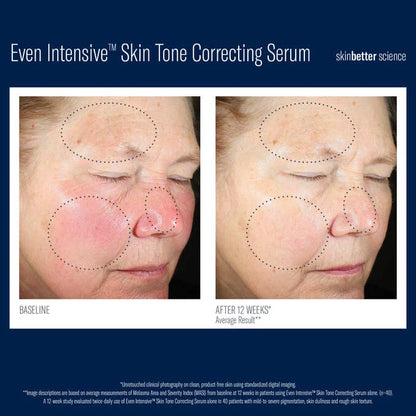 SkinBetter Even Intensive Skin Tone Correcting Serum