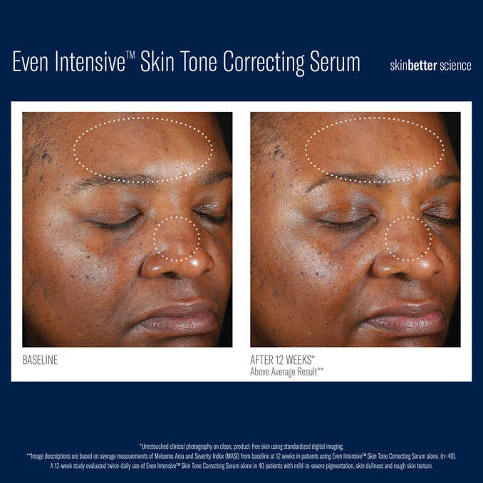 SkinBetter Even Intensive Skin Tone Correcting Serum